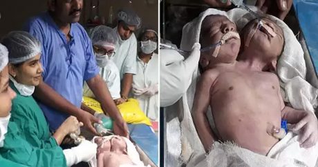 В Индии родился ребенок с двумя головами – ВИДЕО