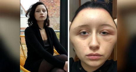 Краска для волос чуть не убила студентку в Париже — ФОТО