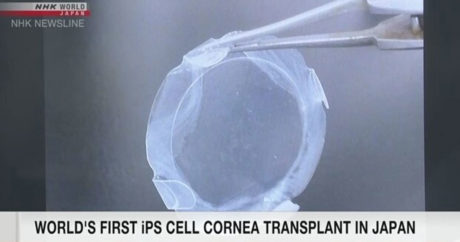 Японские исследователи провели первую пересадку роговицы, полученной из iPS-клеток человека