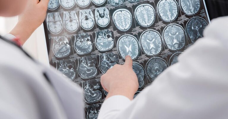 Ученые нашли простой способ обнаружить болезнь Альцгеймера
