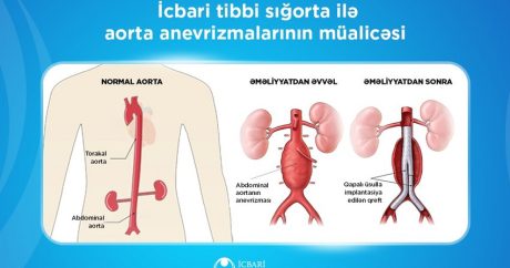 В 2024 году по ОМС выполнено 256 операций по протезированию аневризмы аорты